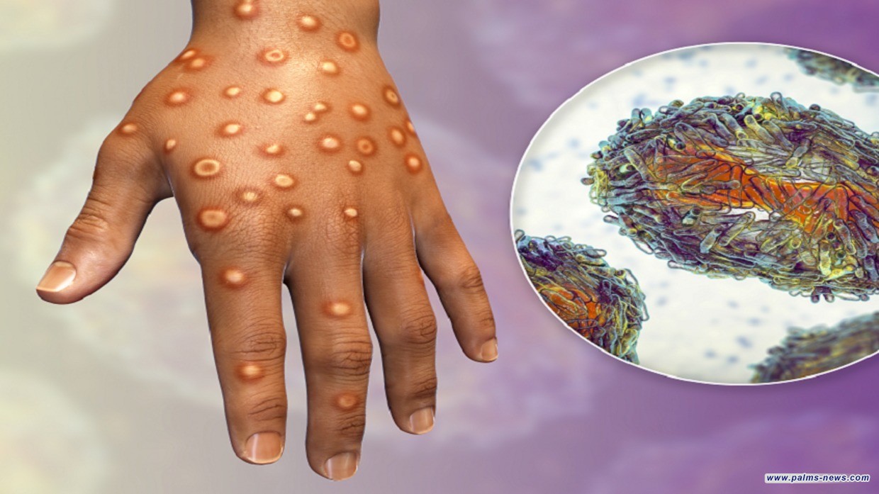 مريض بجدري القردة يكشف عن أعراض مؤلمة ينبغي الدراية بها