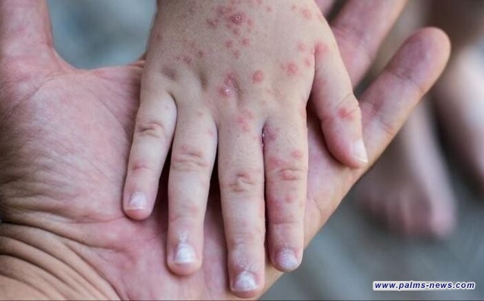 الصحة العالمية تعلن جدري القرود حالة طوارئ صحية عامة