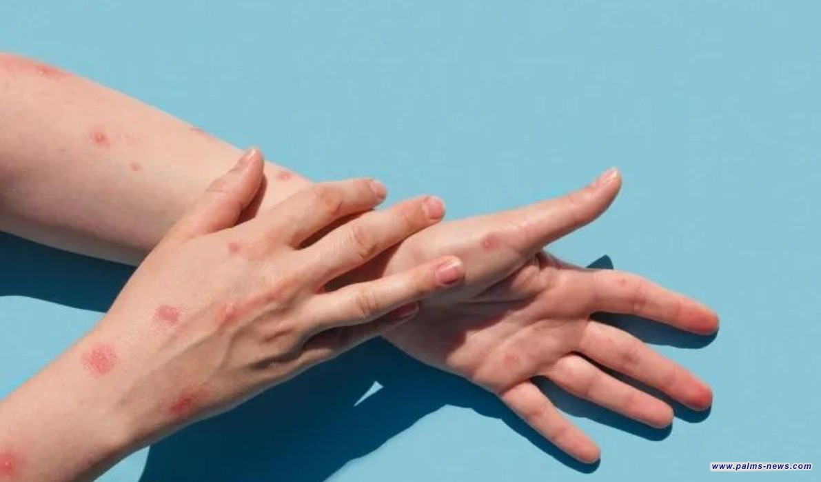 المغرب أول دولة عربية تسجل إصابة بجدري القردة