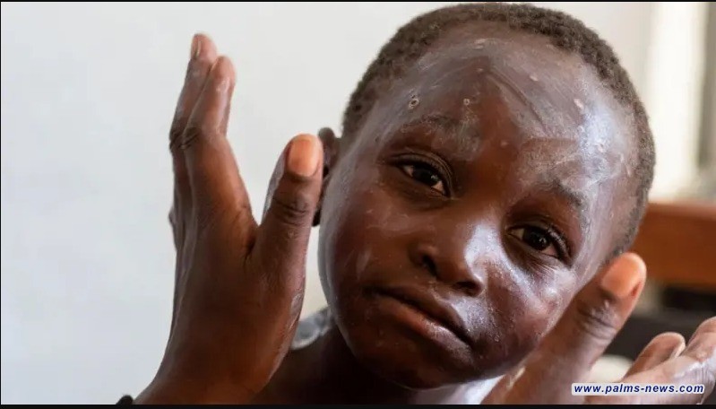 هل يجب أن نقلق من جدري القرود؟