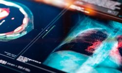 طبيب روسي يحذر من تطور سرطان الرئة دون أعراض