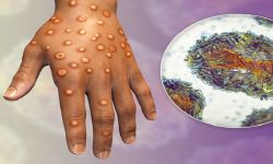 مريض بجدري القردة يكشف عن أعراض مؤلمة ينبغي الدراية بها