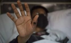 الأردن تسجل إصابة بجدري القردة