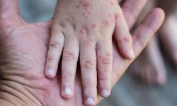 الصحة العالمية تعلن جدري القرود حالة طوارئ صحية عامة