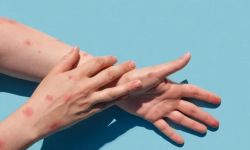 المغرب أول دولة عربية تسجل إصابة بجدري القردة