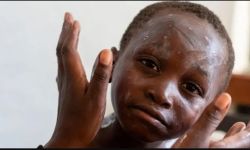 هل يجب أن نقلق من جدري القرود؟