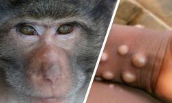 سلالة جديدة من جدري القردة مكتشفة في الكونغو تتسلل إلى تايلاند والسويد